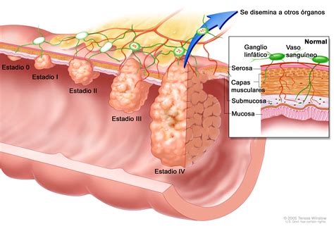 etapas del cancer de colon sigmoidoscopias blog