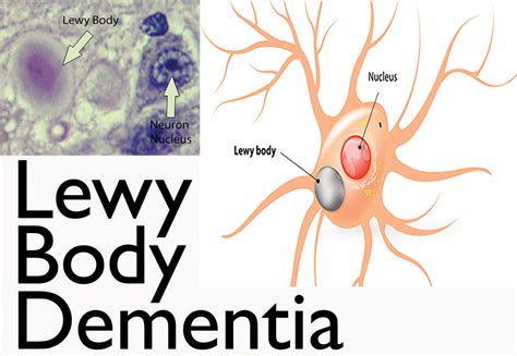 dementia  lewy bodies interactive health