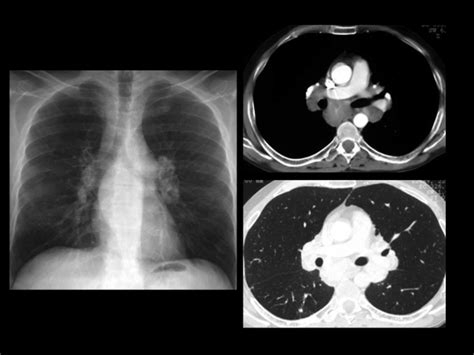 Hilar And Mediastinal Adenopathy In A 32 Year Old Man Chest Radiograph