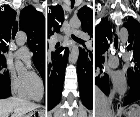 Mediastinal Enlarged Lymph Nodes With Calcification In Tb And Silicosis