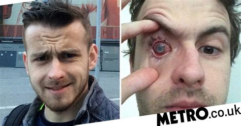 Man Blinded By Parasite In Eye After He Showered With Contact Lenses