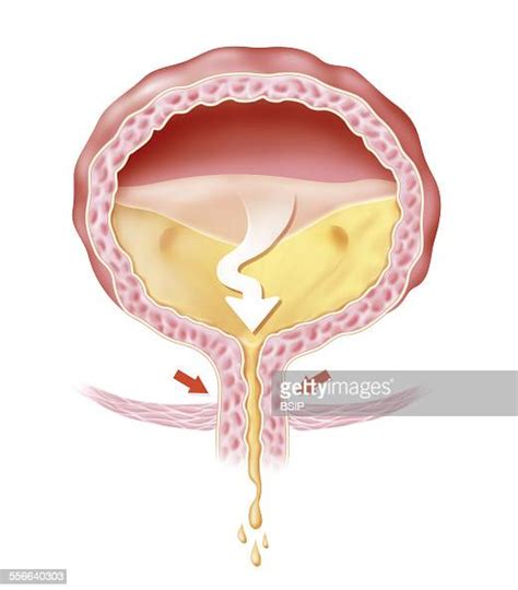 Overactive Bladder Illustration Of Urinary Incontinence The Pelvic