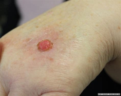 scc squamous cell carcinoma south east skin clinic