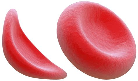 sickle cell anemia facts  disease   worried   cookware