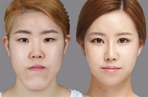 Crazy Before And After Photos Of South Korean Plastic