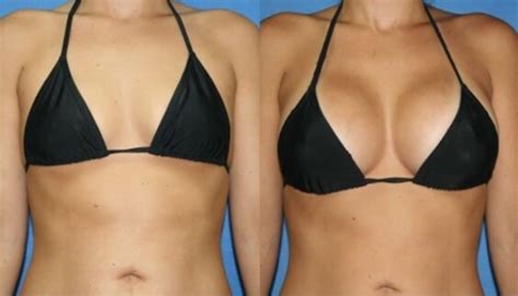 hyaluronic acid breast augmentation injection filler breast