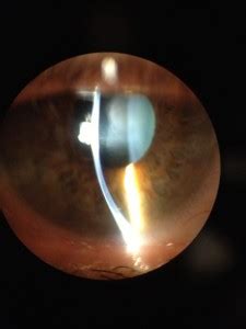 wetting  dry front surface  wearing  scleral lens