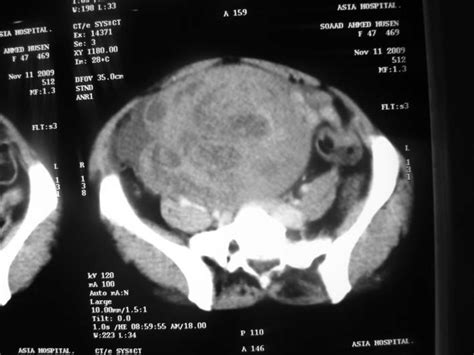 ct scan or ultrasound for ovarian cyst ct scan machine