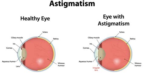 questions about astigmatism