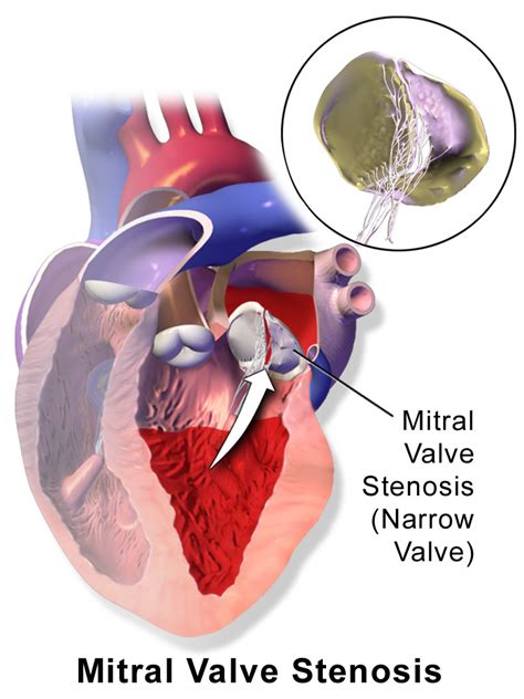 Mitral Valve Stenosis Mexico Pdf Ppt Case Reports