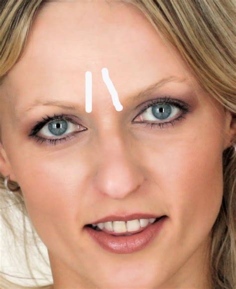 how to remove wrinkles between eyebrows furrow lines