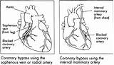 Bypass Coronary Artery Grafting Grafts Ahajournals sketch template