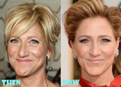 edie falco plastic surgery before and after photos