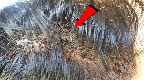 extremely severe head lice combing  beautiful long hair youtube