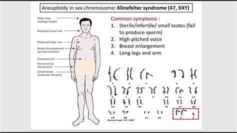 7 3 J Klinefelter Syndrome In Male Aneuploidy In Sex Chromosome