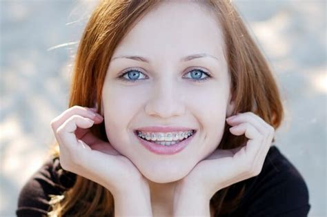 10 best tips for kissing someone with braces fgf blog