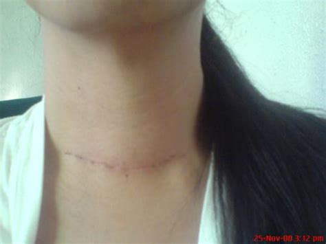 Scar Issue Be Shy And Go To The Dermatologist Or Be Proud