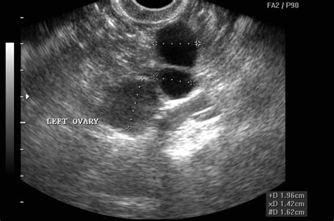 Ovarian Cancer Tumor Ultrasound