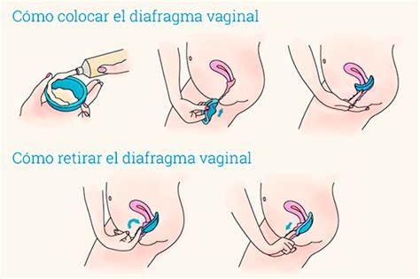 colocación y uso del diafragma vaginal consejos y