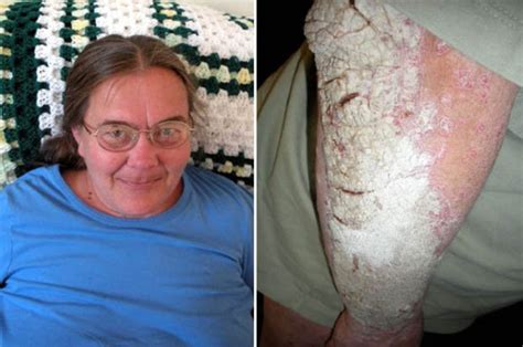 psoriasis causes woman skin to become covered in huge scaly patches of