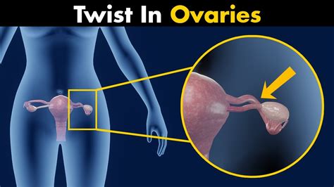 ovarian torsion symptoms   treatment  animation youtube