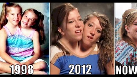 Interesting Things About Famous Conjoined Twins Abby And Brittany
