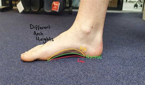 flat feet  arched feet   differences   treat