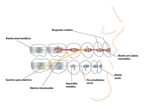 aparelho image min alexandre moro ortodontia