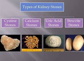 Image result for kidneys stones