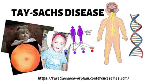 Read This Controversial Blog And Find Out More About Tay Sachs Disease