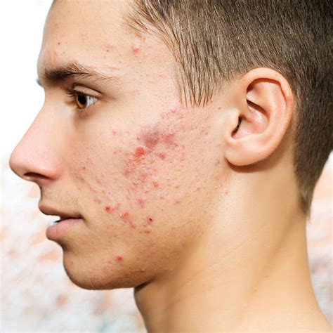 royalty  pimple pictures images  stock  istock
