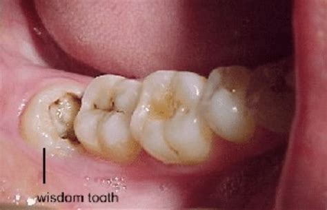 wisdom teeth removal  french dental services drmiski