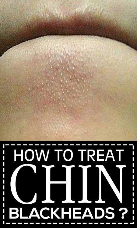 how to get rid of blackheads on the chin fast at home