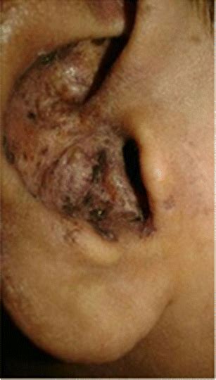 Clinical Photograph Depicting Discoid Skin Lesions Over External Ear In