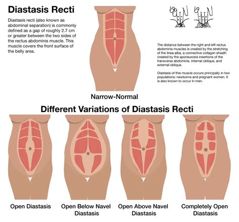 diastasis recti physiotherapy treatments in greenwich london pelvicare