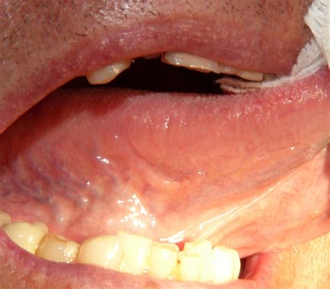 papillary lesion  tongue squamous papilloma  tongue squamous