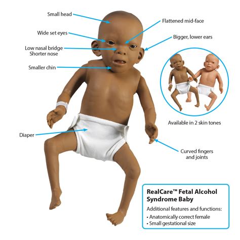 realcare fetal alcohol syndrome baby ubicaciondepersonascdmxgobmx