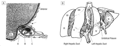 Operative Repair Of Bile Duct Injuries Involving The Hepatic Duct