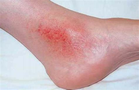 Skin Rash Of The Ankle Varicose Veins Mn Minnesota