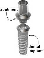 dental implant abutment