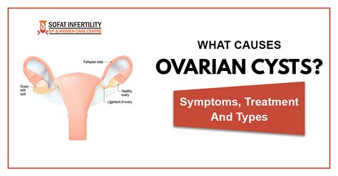 What Is Ovarian Cyst Causes Symptoms Treatment Types