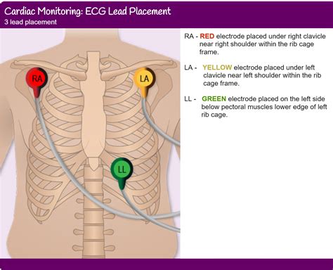 leads ecg cable  placement yqf medical cable