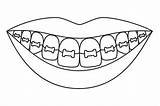 Braces Teeth Drawing Smile Coloring Line Illustrations Vector Dental Clip Tooth Healthy Kids Dentist Stock Illustration sketch template