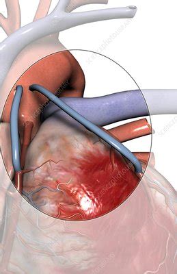 heart bypass stock image  science photo library