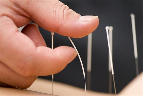 acupuncture feel  dreamclinic massage  seattle