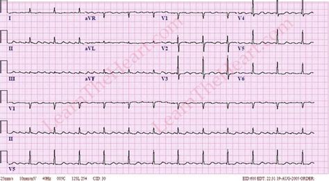 Atrial Flutter With 4 1 Conduction Ecg 1