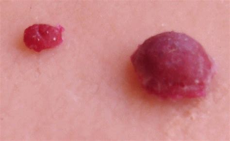 cherry angiomas pictures symptoms causes treatment