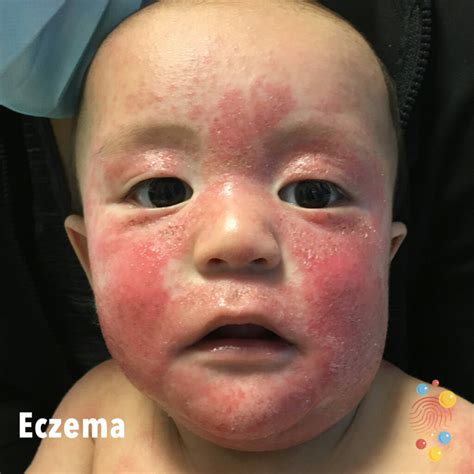eczema skin deep