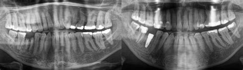 Immediate Implant In First Molar Wimpole Street Dental Clinic