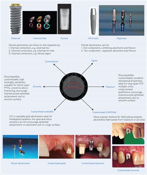 implant abutments pocket dentistry